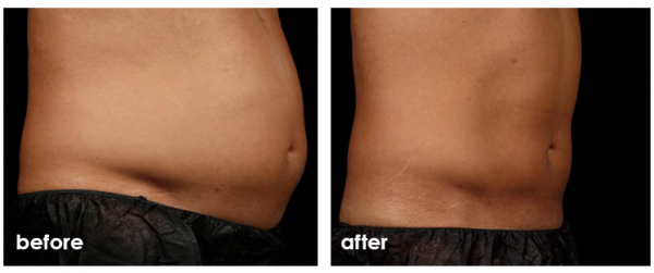 SculpSure WarmSculpting in Ohio - 25-Minute Body Contouring